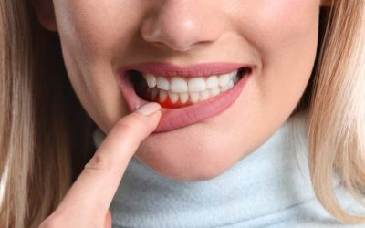 Blödande tandkött – vad ska man göra?